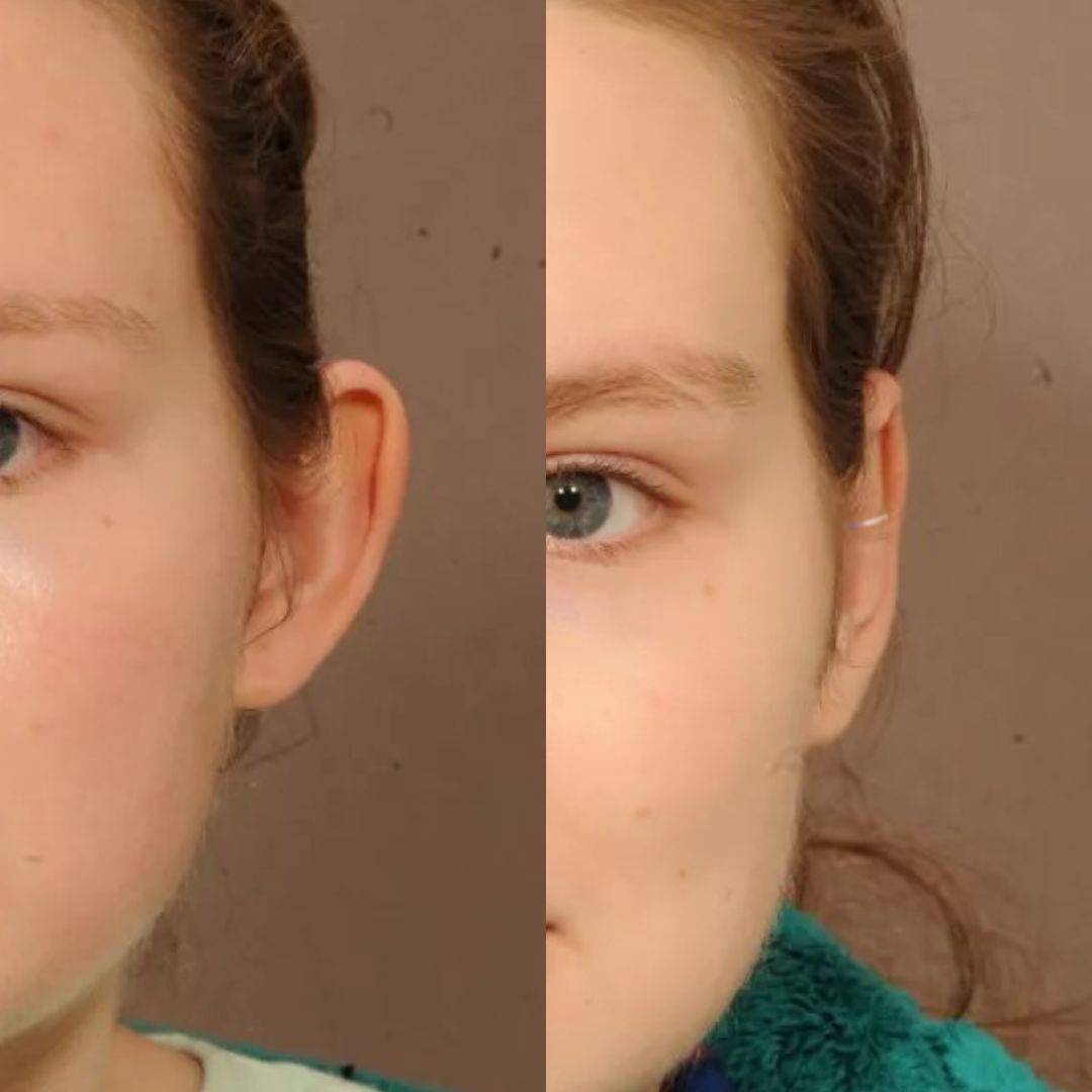 Pince correctrice d'oreilles