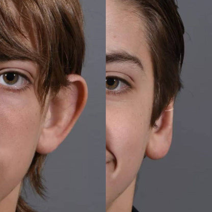 Pince correctrice d'oreilles